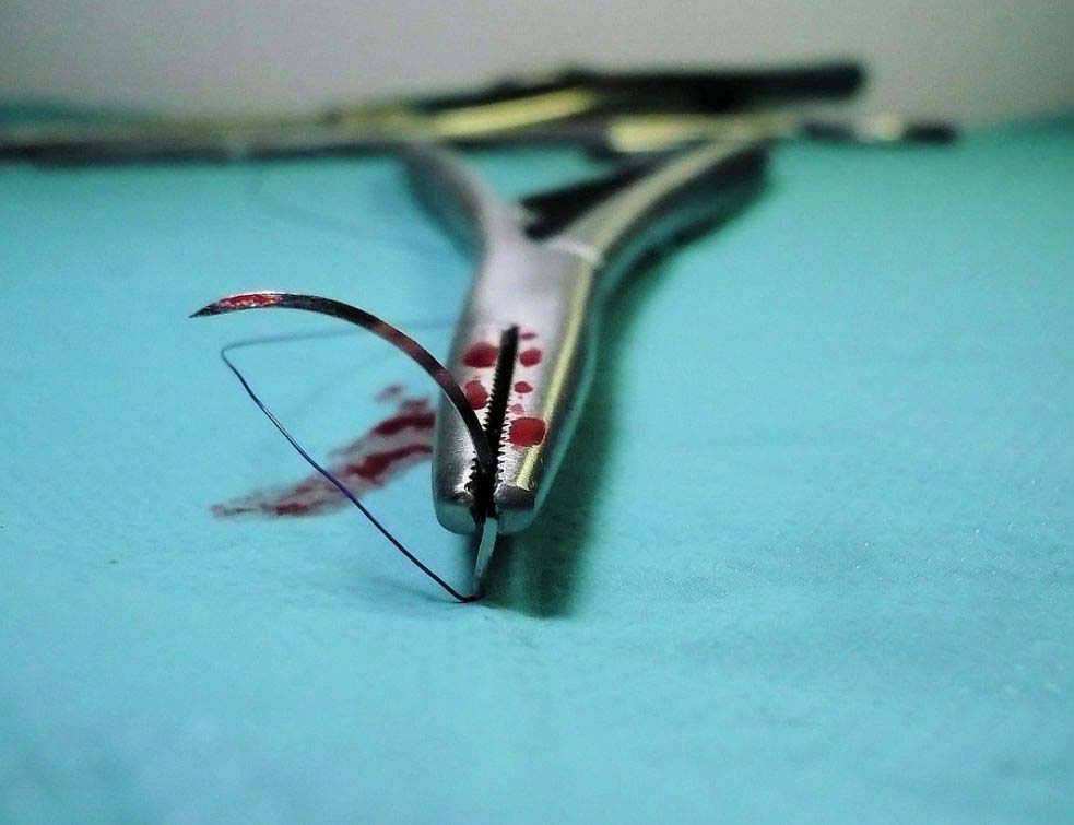 Operacija - hirurgija